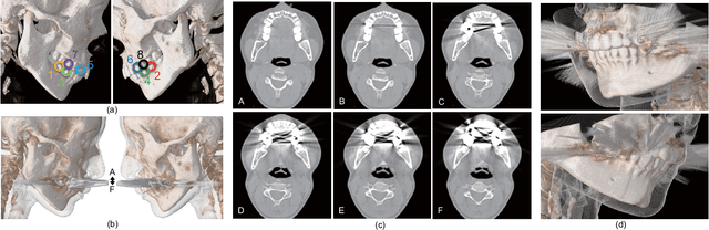 Figure 4 for Three-dimensional Generative Adversarial Nets for Unsupervised Metal Artifact Reduction