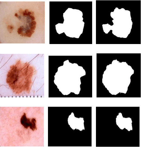 Figure 1 for Skin Cancer Segmentation and Classification with NABLA-N and Inception Recurrent Residual Convolutional Networks