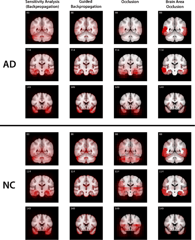 Figure 1 for Visualizing Convolutional Networks for MRI-based Diagnosis of Alzheimer's Disease