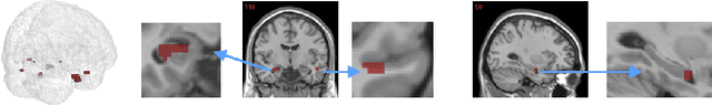 Figure 3 for Leveraging both Lesion Features and Procedural Bias in Neuroimaging: An Dual-Task Split dynamics of inverse scale space