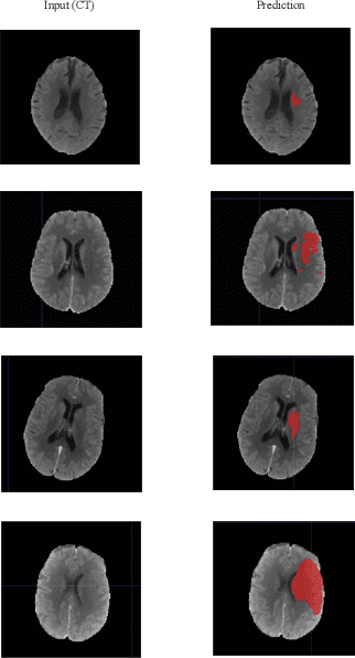 Figure 3 for Ischemic Stroke Lesion Segmentation Using Adversarial Learning