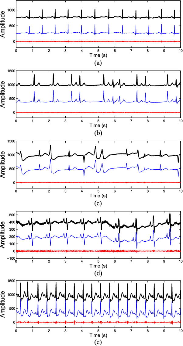 Figure 4 for A Novel Blaschke Unwinding Adaptive Fourier Decomposition based Signal Compression Algorithm with Application on ECG Signals