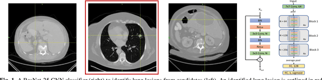 Figure 1 for A deep learning-facilitated radiomics solution for the prediction of lung lesion shrinkage in non-small cell lung cancer trials
