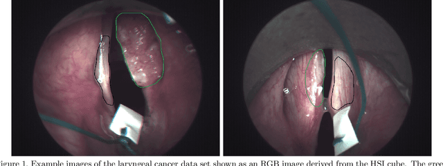 Figure 1 for Spatio-spectral deep learning methods for in-vivo hyperspectral laryngeal cancer detection