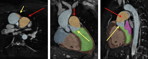 Figure 1 for Multi-Atlas Based Pathological Stratification of d-TGA Congenital Heart Disease