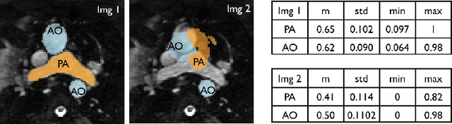 Figure 2 for Multi-Atlas Based Pathological Stratification of d-TGA Congenital Heart Disease