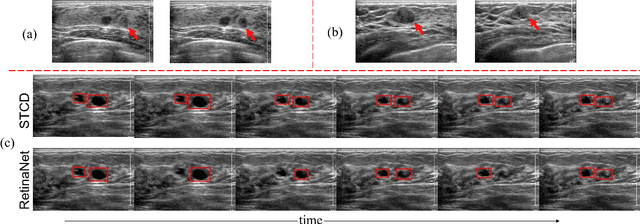 Figure 1 for Semi-supervised Breast Lesion Detection in Ultrasound Video Based on Temporal Coherence