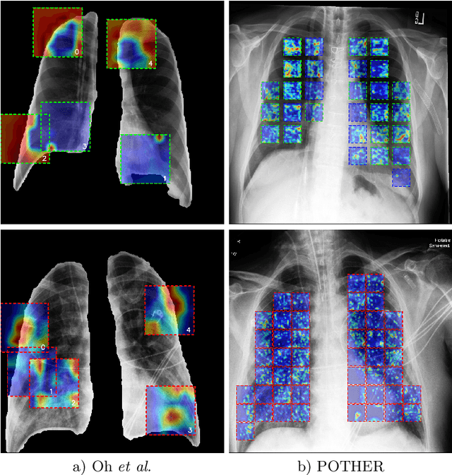 Figure 4 for POTHER: Patch-Voted Deep Learning-based Chest X-ray Bias Analysis for COVID-19 Detection