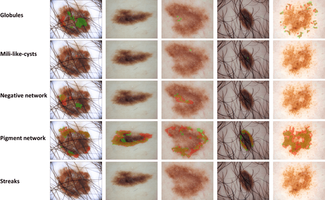 Figure 3 for Leveraging Transfer Learning for Segmenting Lesions and their Attributes in Dermoscopy Images