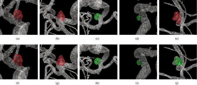 Figure 2 for Detecting intracranial aneurysm rupture from 3D surfaces using a novel GraphNet approach