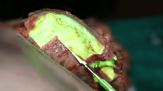 Figure 4 for Depth Camera Based Particle Filter for Robotic Osteotomy Navigation