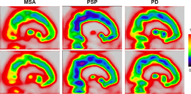 Figure 3 for Learning Optimal Deep Projection of $^{18}$F-FDG PET Imaging for Early Differential Diagnosis of Parkinsonian Syndromes