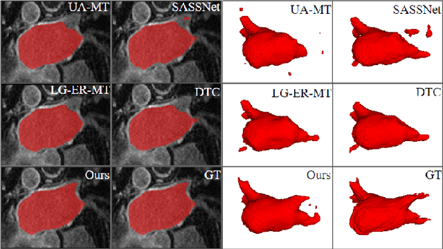 Figure 2 for Hierarchical Consistency Regularized Mean Teacher for Semi-supervised 3D Left Atrium Segmentation