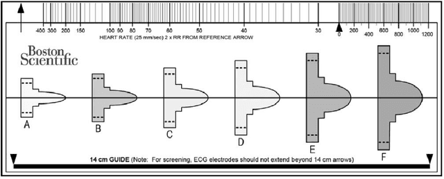 Figure 3 for Deep learning methods for screening patients' S-ICD implantation eligibility