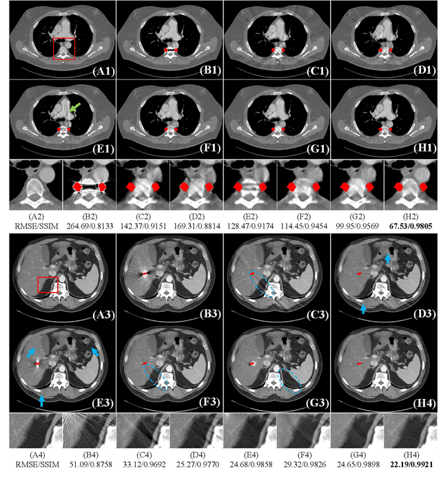 Figure 3 for Deep Sinogram Completion with Image Prior for Metal Artifact Reduction in CT Images