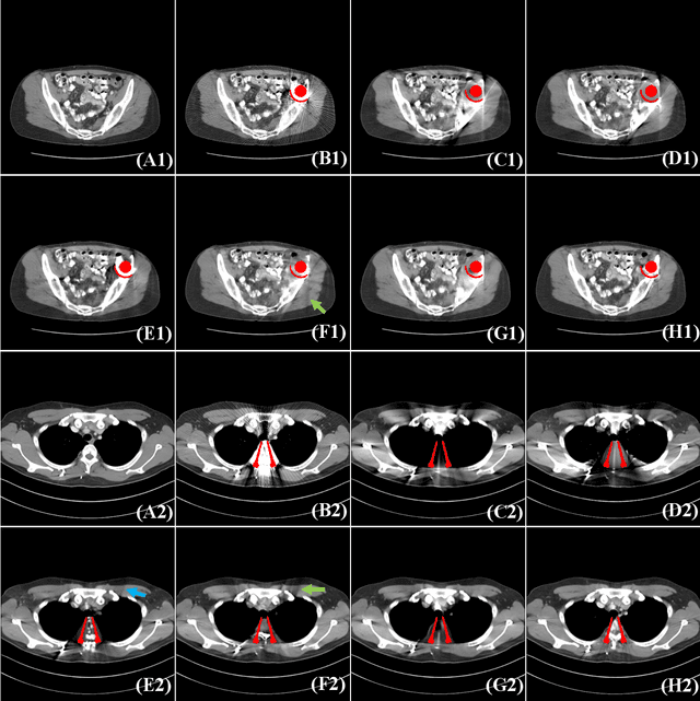Figure 4 for Deep Sinogram Completion with Image Prior for Metal Artifact Reduction in CT Images
