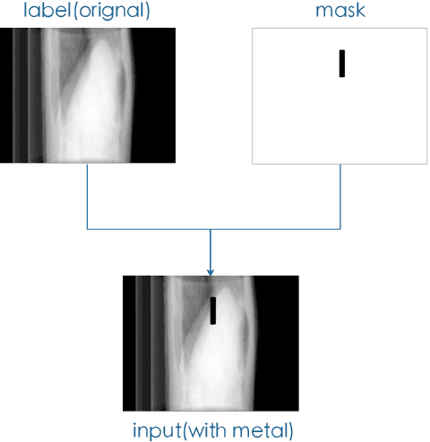 Figure 3 for Projection Inpainting Using Partial Convolution for Metal Artifact Reduction