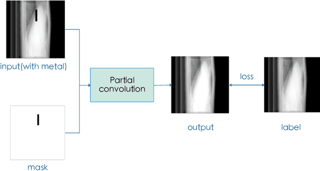 Figure 4 for Projection Inpainting Using Partial Convolution for Metal Artifact Reduction
