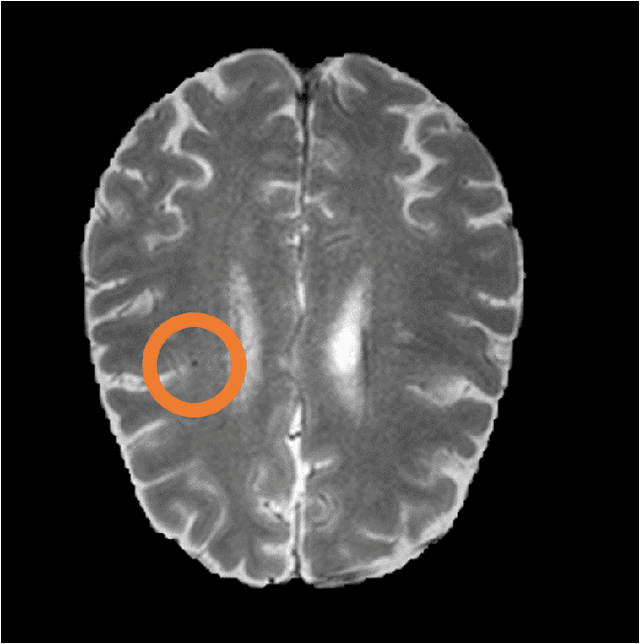 Figure 2 for MixMicrobleedNet: segmentation of cerebral microbleeds using nnU-Net