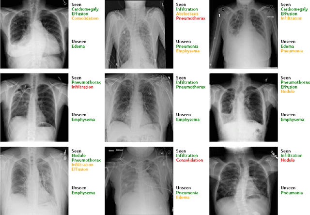 Figure 4 for Multi-Label Generalized Zero Shot Learning for the Classification of Disease in Chest Radiographs