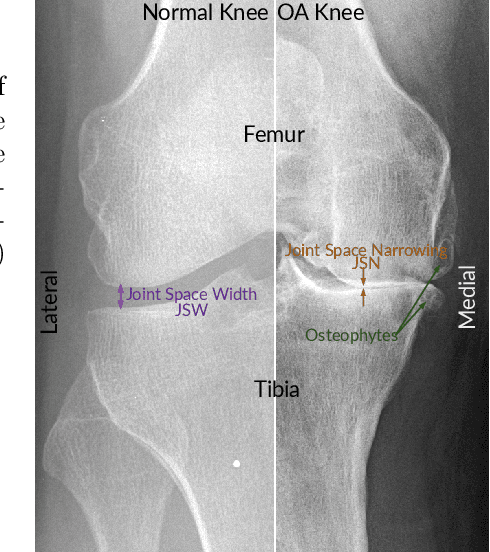 Figure 1 for A Lightweight CNN and Joint Shape-Joint Space Descriptor for Radiological Osteoarthritis Detection