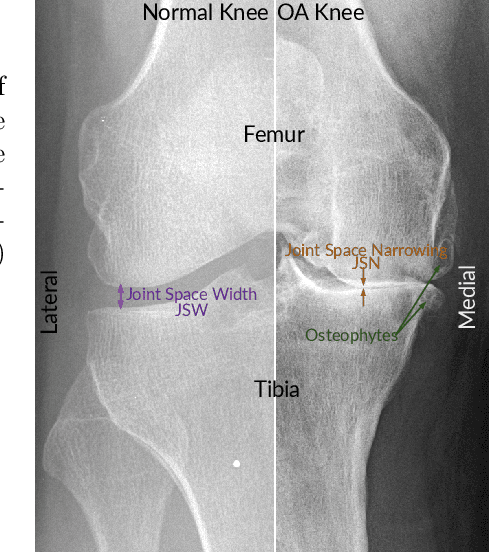 Figure 1 for A Lightweight CNN and Joint Shape-Joint Space (JS2) Descriptor for Radiological Osteoarthritis Detection