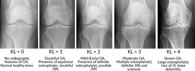 Figure 3 for A Lightweight CNN and Joint Shape-Joint Space Descriptor for Radiological Osteoarthritis Detection