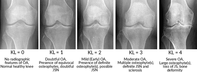 Figure 3 for A Lightweight CNN and Joint Shape-Joint Space (JS2) Descriptor for Radiological Osteoarthritis Detection
