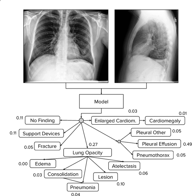 Figure 1 for CheXpert: A Large Chest Radiograph Dataset with Uncertainty Labels and Expert Comparison