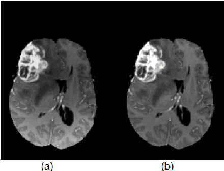 Figure 3 for Segmentation of Glioma Tumors in Brain Using Deep Convolutional Neural Network