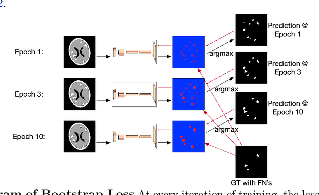 Figure 3 for Brain Metastasis Segmentation Network Trained with Robustness to Annotations with Multiple False Negatives