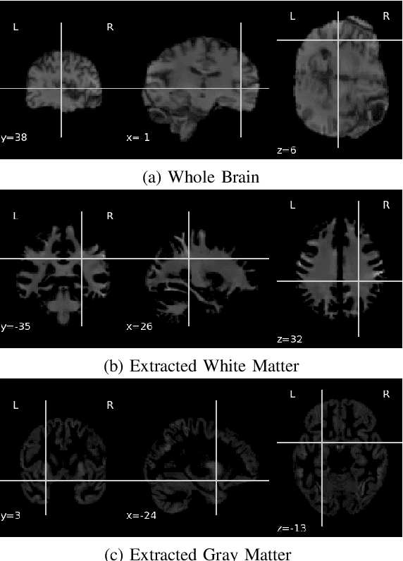 Figure 2 for Parkinson's Disease Detection Using Ensemble Architecture from MR Images