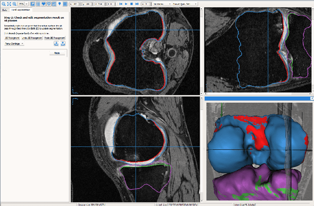 Figure 1 for Just-Enough Interaction Approach to Knee MRI Segmentation: Data from the Osteoarthritis Initiative