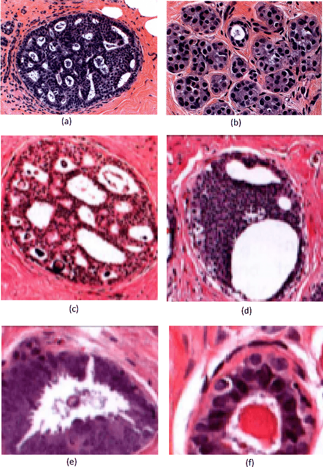 Figure 1 for Evaluation of Joint Multi-Instance Multi-Label Learning For Breast Cancer Diagnosis