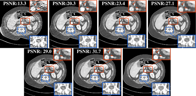 Figure 4 for SUPER Learning: A Supervised-Unsupervised Framework for Low-Dose CT Image Reconstruction