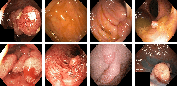 Figure 1 for A Comprehensive Study on Colorectal Polyp Segmentation with ResUNet++, Conditional Random Field and Test-Time Augmentation