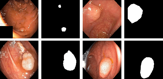 Figure 3 for A Comprehensive Study on Colorectal Polyp Segmentation with ResUNet++, Conditional Random Field and Test-Time Augmentation