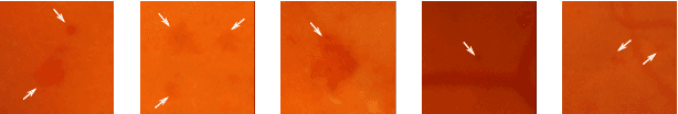 Figure 1 for An Ensemble Deep Learning Based Approach for Red Lesion Detection in Fundus Images