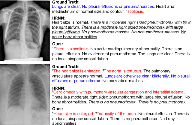 Figure 1 for Exploring and Distilling Posterior and Prior Knowledge for Radiology Report Generation