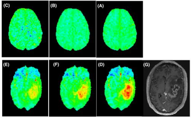 Figure 4 for snapshot CEST++ : the next snapshot CEST for fast whole-brain APTw imaging at 3T