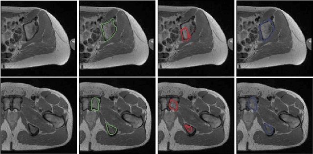 Figure 3 for Deep Learning with Anatomical Priors: Imitating Enhanced Autoencoders in Latent Space for Improved Pelvic Bone Segmentation in MRI