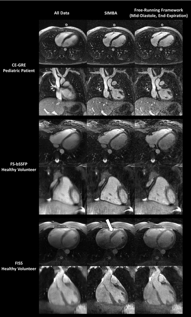 Figure 3 for Free-running SIMilarity-Based Angiography (SIMBA) for simplified anatomical MR imaging of the heart