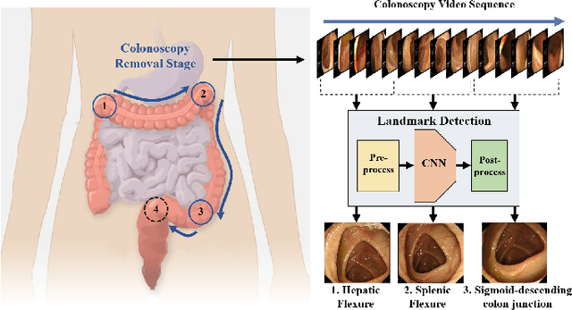 Figure 1 for Deep Learning-based Biological Anatomical Landmark Detection in Colonoscopy Videos