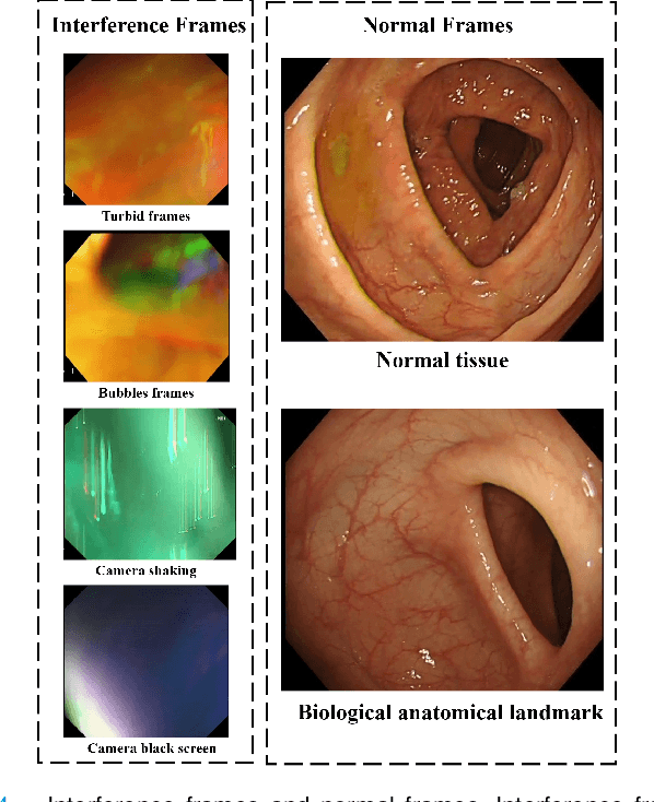 Figure 4 for Deep Learning-based Biological Anatomical Landmark Detection in Colonoscopy Videos