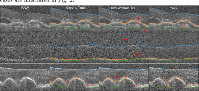 Figure 4 for A deep learning network with differentiable dynamic programming for retina OCT surface segmentation