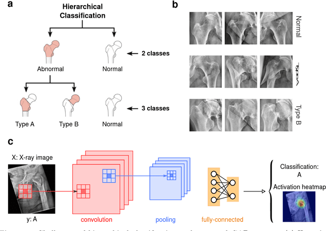 Figure 1 for Towards an Interactive and Interpretable CAD System to Support Proximal Femur Fracture Classification