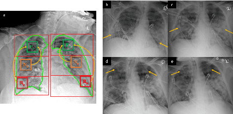 Figure 1 for Attention-based Multi-scale Gated Recurrent Encoder with Novel Correlation Loss for COVID-19 Progression Prediction