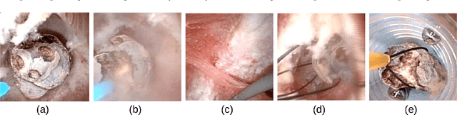 Figure 1 for Deep morphological recognition of kidney stones using intra-operative endoscopic digital videos