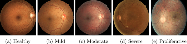 Figure 1 for Combining Fine- and Coarse-Grained Classifiers for Diabetic Retinopathy Detection