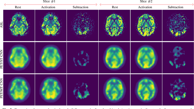 Figure 3 for ASL to PET Translation by a Semi-supervised Residual-based Attention-guided Convolutional Neural Network